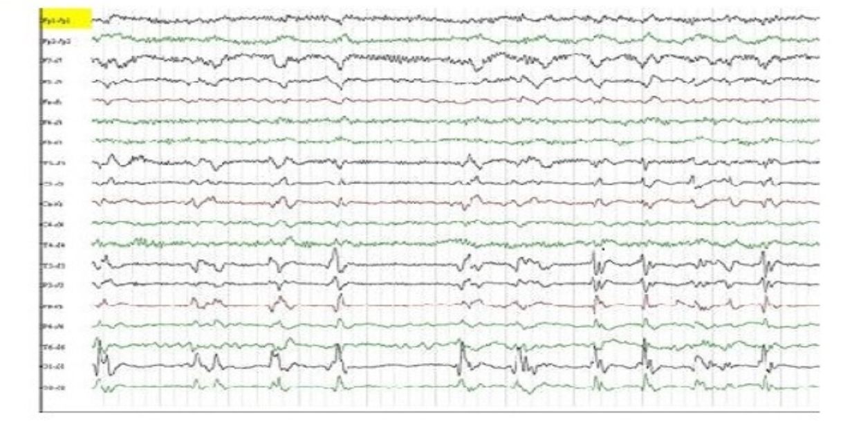 Epilepsie - Asklepios Klinik Nord Heidberg